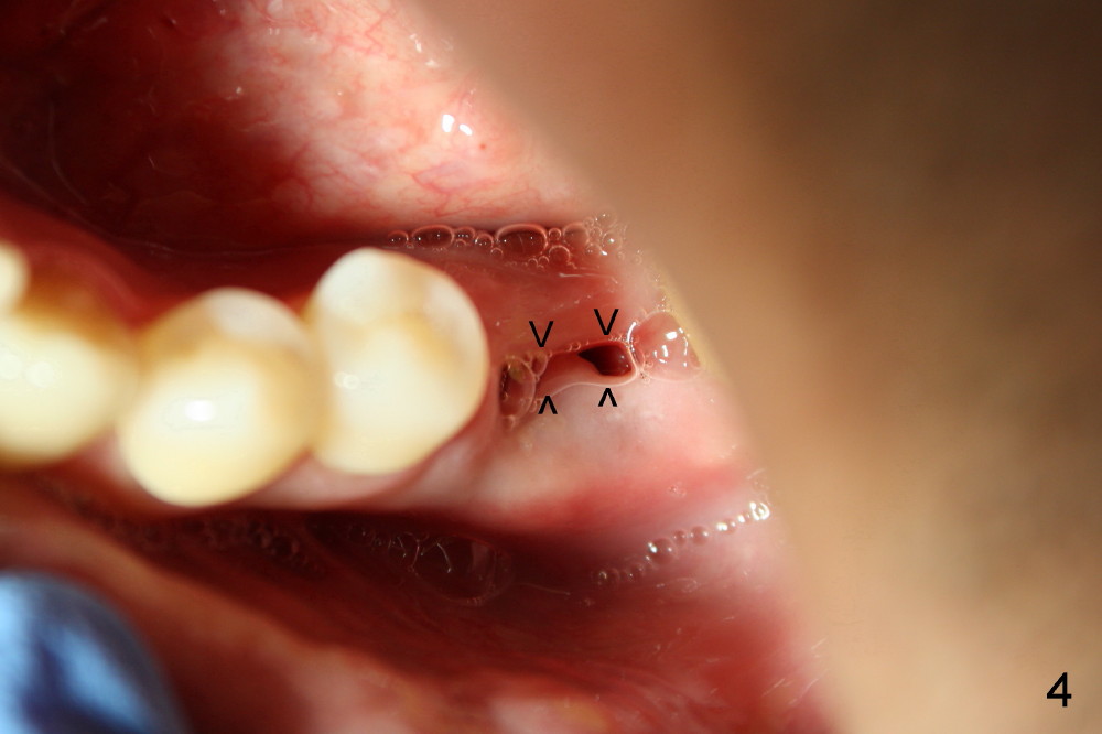 Platelet reduction and extraction, implant, Dental Education Lecture